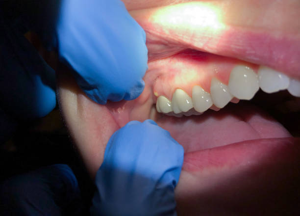 Best Emergency Dental Care for Broken or Chipped Teeth in Tilden, NE